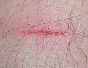 スマホの画面傷を修理するための最適な方法は？