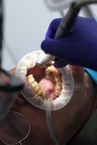 ホワイトニングを受ける際の歯医者での費用はどのくらい？